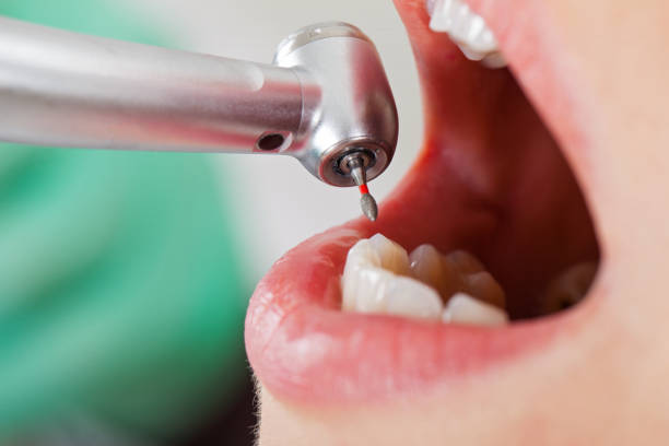 Best Dental Abscess Treatment in Silver Lakes, CA